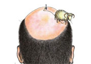 禿頂會(huì)遺傳嗎？治療禿頂?shù)姆椒ㄊ鞘裁矗?><p><strong>禿頂會(huì)遺傳嗎？治療禿頂?shù)姆椒ㄊ鞘裁矗?/strong></p></a></li> </ul>
</div>
<div   id=