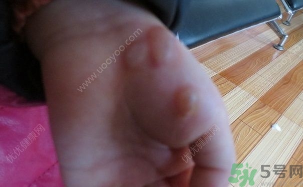 15歲還會得手足口病嗎？手足口病的癥狀有哪些？