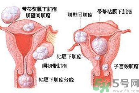 ?子宮移位怎么治療？子宮移位能懷孕嗎？