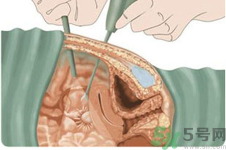 子宮移位的原因是什么？子宮移位的癥狀有哪些？