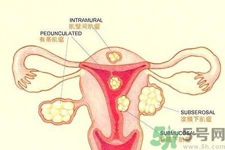 子宮移位的原因是什么？子宮移位的癥狀有哪些？