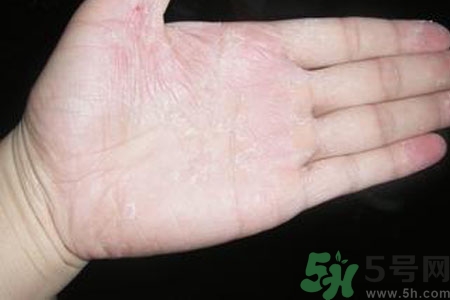 ?手掌脫皮的危害有哪些？如何預(yù)防手掌脫皮？