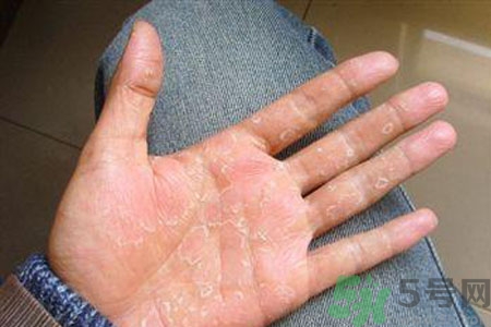 ?手掌脫皮的危害有哪些？如何預(yù)防手掌脫皮？