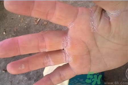 手脫皮是什么原因？手脫皮的治療方法是什么？