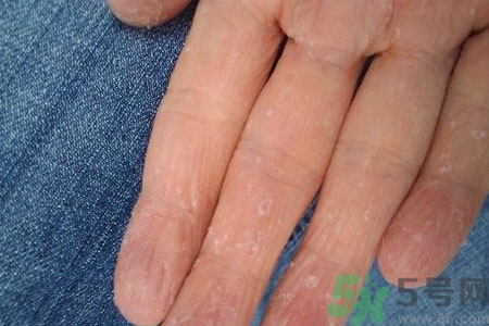 手脫皮是什么原因？手脫皮的治療方法是什么？