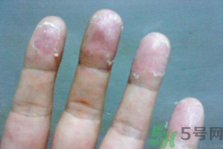 手脫皮是什么原因？手脫皮的治療方法是什么？