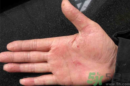 手脫皮是什么原因？手脫皮的治療方法是什么？