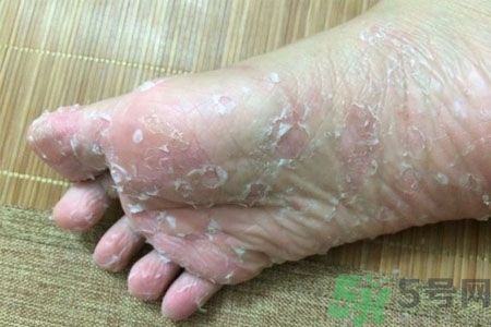 腳脫皮是怎么回事？腳脫皮怎么辦？