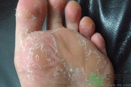 腳脫皮的治療方法有哪些？如何預(yù)防腳脫皮？