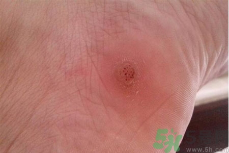腳上長雞眼是怎么回事？腳上長雞眼是怎么辦？