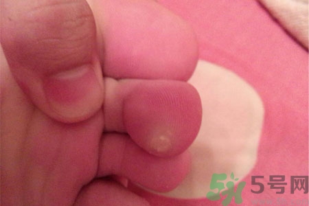 雞眼怎么能徹底根治？如何預防腳上長雞眼？