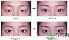 提眉術(shù)后多久可以恢復(fù)？提眉術(shù)后全過(guò)程照片