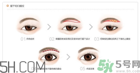 切眉手術(shù)后老得快嗎？切眉能保持多久？