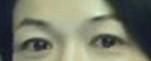 提眉術(shù)后多久可以恢復(fù)？提眉術(shù)后全過(guò)程照片