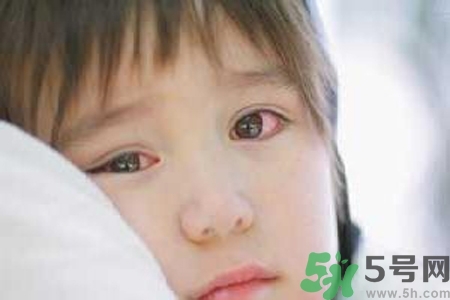 流行性腮腺炎的表現(xiàn)有哪些？?流行性腮腺炎飲食怎么調(diào)理？