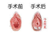 處女膜修補(bǔ)術(shù)效果怎么樣？處女膜修復(fù)手術(shù)有風(fēng)險(xiǎn)嗎？