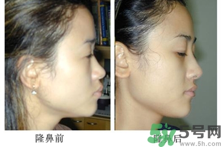 玻尿酸隆鼻的危害有哪些？玻尿酸隆鼻的副作用是什么？