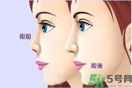玻尿酸隆鼻的缺點是什么？玻尿酸隆鼻的優(yōu)點有哪些？
