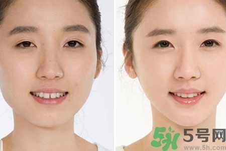 玻尿酸隆鼻的缺點是什么？玻尿酸隆鼻的優(yōu)點有哪些？