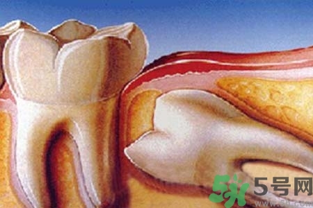 智齒橫著長怎么辦？智齒橫著長一定要拔了嗎？