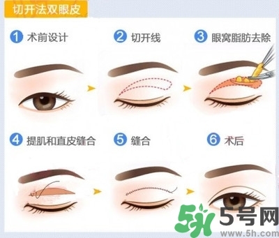 雙眼皮手術(shù)哪種最好？割雙眼皮后注意些什么？