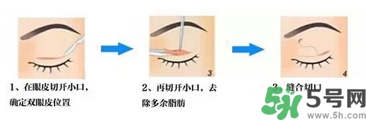 雙眼皮手術(shù)哪種最好？割雙眼皮后注意些什么？