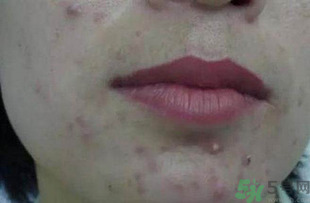 什么樣的痘痘能擠？哪些痘痘不能擠？