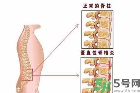 僵直性脊椎炎的癥狀有哪些？怎樣預(yù)防僵直性脊椎炎？