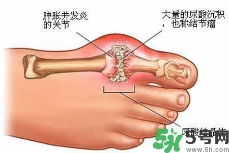 引發(fā)痛風的原因是什么？痛風病人飲食需注意什么好？