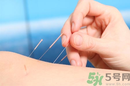 針灸一次要扎多長時間？針灸可以幾天做一次？