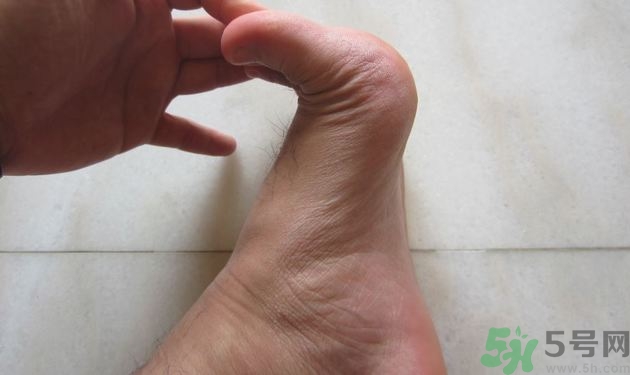 腳拇指外翻遺傳嗎？腳拇指外翻怎么矯正？