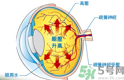 青光眼可以治愈嗎？青光眼怎樣治療？