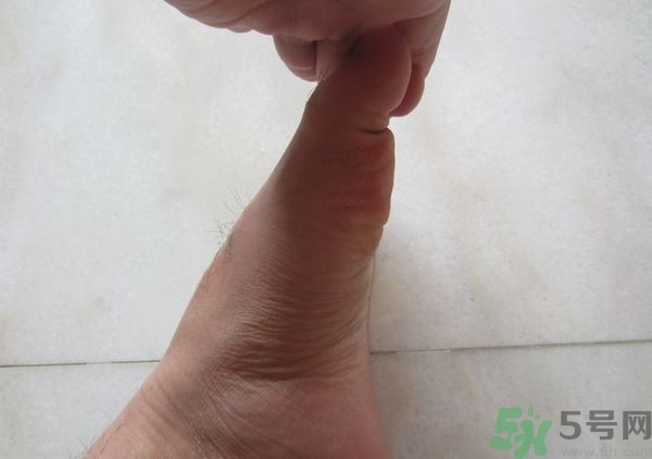 腳拇指外翻遺傳嗎？腳拇指外翻怎么矯正？