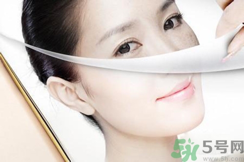 曬斑可以自己消退嗎？曬斑可以用激光去除嗎？