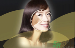曬斑可以自己消退嗎？曬斑可以用激光去除嗎？