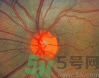 青光眼可以治愈嗎？青光眼怎樣治療？