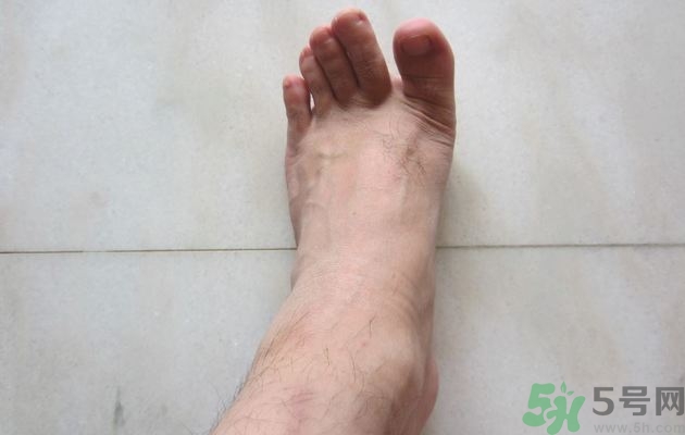 腳拇指外翻遺傳嗎？腳拇指外翻怎么矯正？