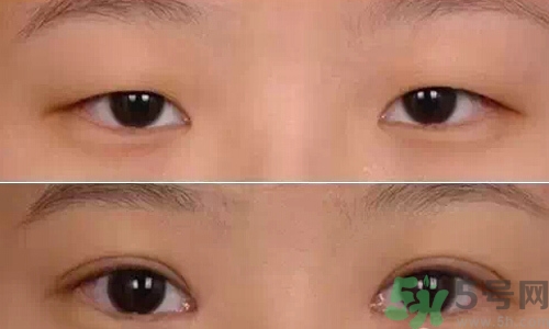 天生腫眼泡怎么消除？天生腫眼泡怎么辦？