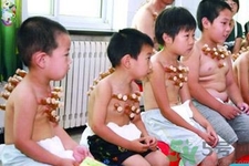 小孩可以拔罐嗎？寶寶能拔火罐嗎？