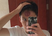頭痛可以在額頭上拔火罐嗎？額頭上拔火罐有什么好處？