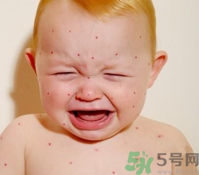 新生兒濕疹怎么引起的？新生兒濕疹如何處理？