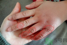 凍瘡為什么容易復(fù)發(fā)？凍瘡反復(fù)發(fā)作怎么辦？