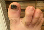 腳趾甲變黑是什么原因？腳趾甲變黑是怎么回事？