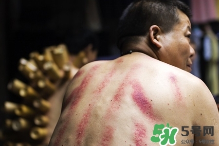 背部刮痧后能拔火罐嗎？背部刮痧后拔火罐有什么好處？