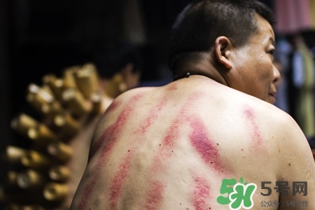 刮痧會(huì)得艾滋嗎？刮痧會(huì)傳染艾滋嗎？