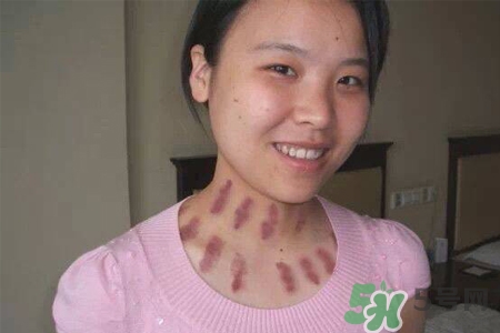 揪痧和刮痧哪個效果比較好？揪痧和刮痧的區(qū)別？