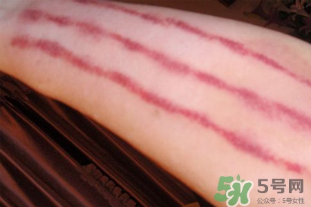 揪痧和刮痧哪個效果比較好？揪痧和刮痧的區(qū)別？