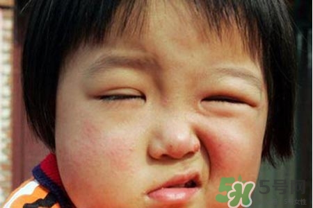面癱能針灸嗎？針灸能治療面癱嗎？