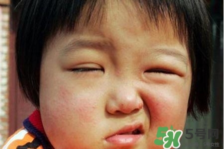 拔牙會導致面癱嗎?？拔牙為什么會導致面癱？