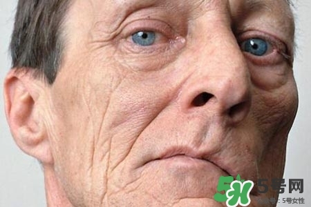 老年人為什么容易得面癱？老年人面癱原因有哪些？